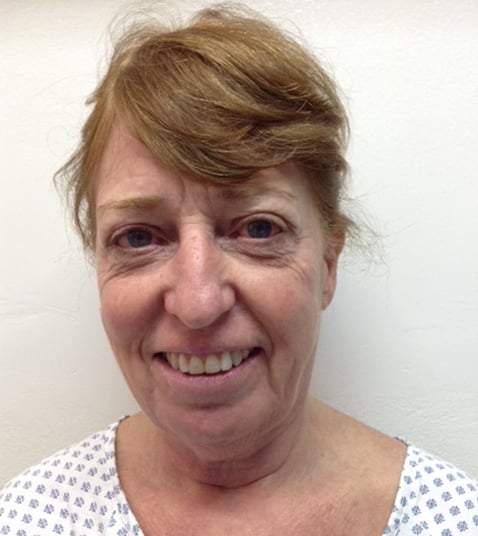 Eyelid Lift