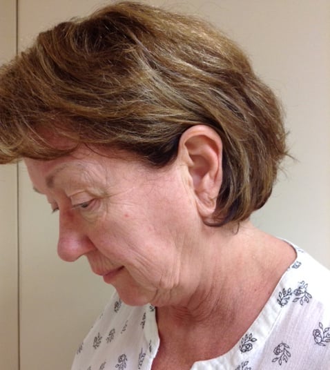 Eyelid Lift