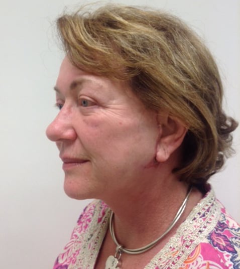Eyelid Lift