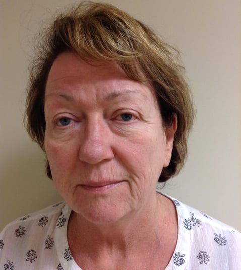 Eyelid Lift