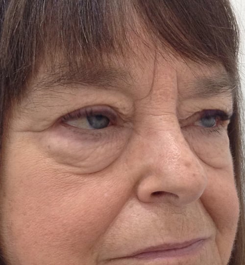 Eyelid Lift