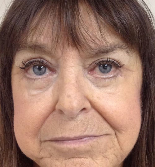 Eyelid Lift