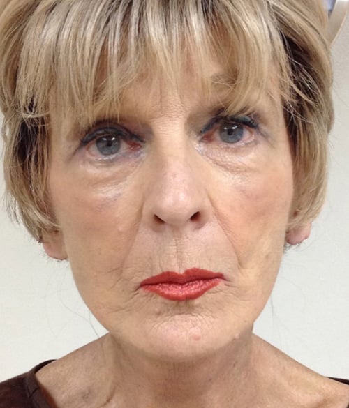 Facelift