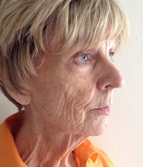 Facelift