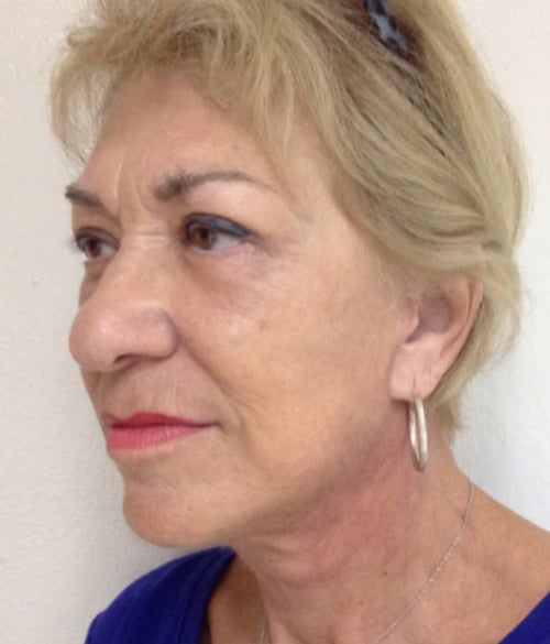 Facelift