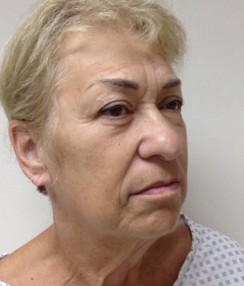 Facelift