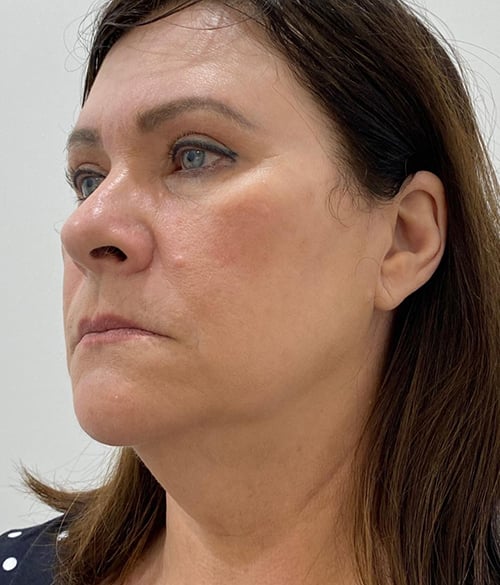 Facelift