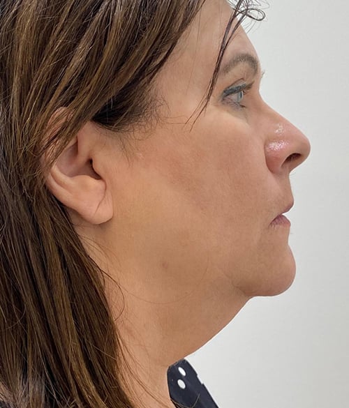 Facelift
