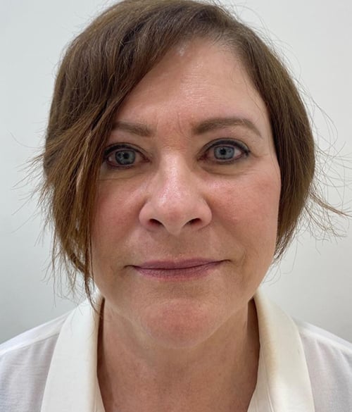 Facelift
