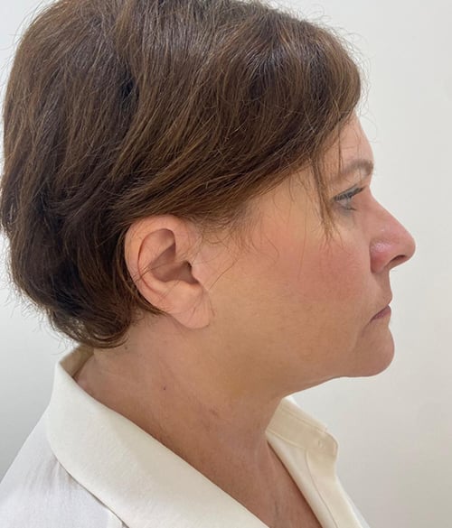 Facelift